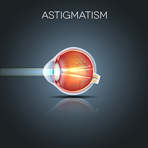 Astigmatizmus myopia