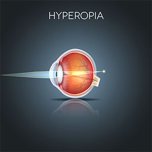 hyperopia plusz 5)